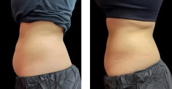 before-after-by-khrom-med-spa-in-Brooklyn-NY