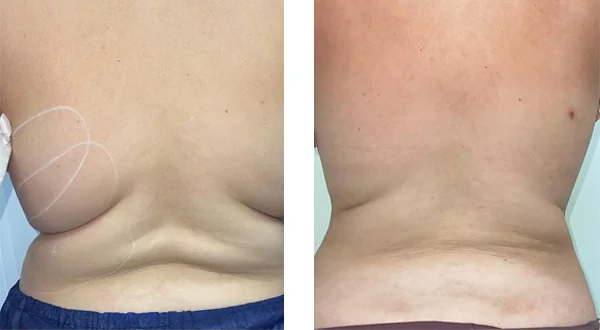 before-after-by-khrom-med-spa-in-Brooklyn-NY