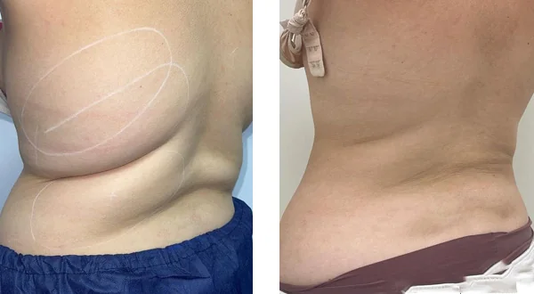 before-after-by-khrom-med-spa-in-Brooklyn-NY