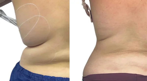 before-after-by-khrom-med-spa-in-Brooklyn-NY