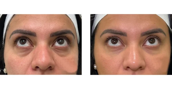 before-after-by-khrom-med-spa-in-Brooklyn-NY