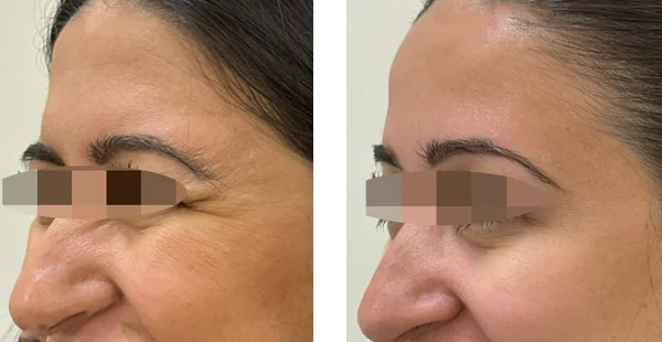 before-after-by-khrom-med-spa-in-Brooklyn-NY