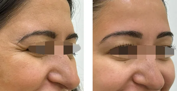 before-after-by-khrom-med-spa-in-Brooklyn-NY