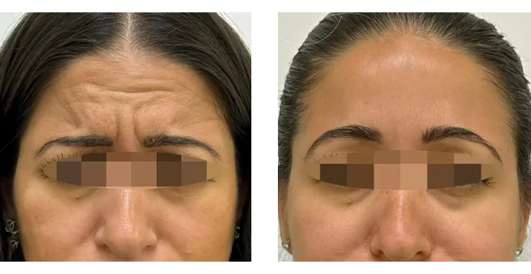 before-after-by-khrom-med-spa-in-Brooklyn-NY