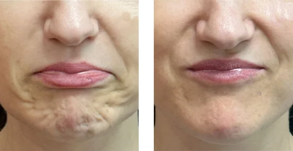 before-after-by-khrom-med-spa-in-Brooklyn-NY