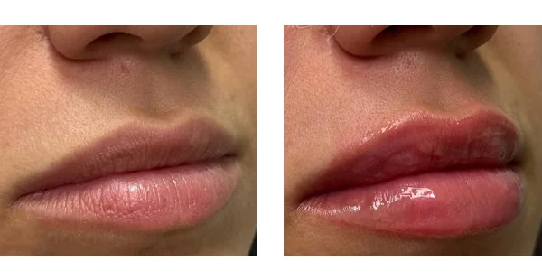 before-after-by-khrom-med-spa-in-Brooklyn-NY