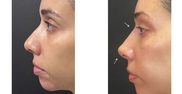 before-after-by-khrom-med-spa-in-Brooklyn-NY