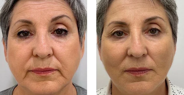Before and After Acne Scarring Treatment