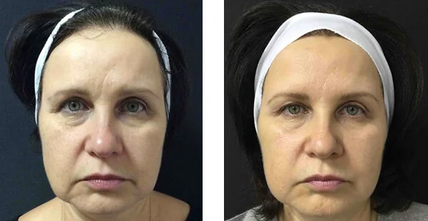 Before and After Acne Scarring Treatment