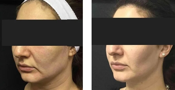 Before and After Acne Scarring Treatment
