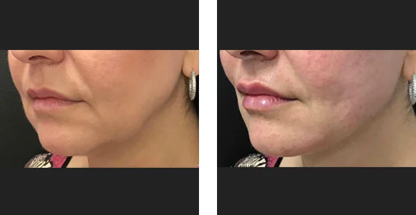 Before and After Image Acne Scarring Treatment