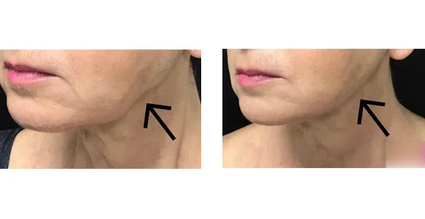 Before and After image