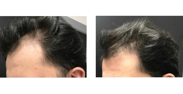 Before and After Hair Restoration