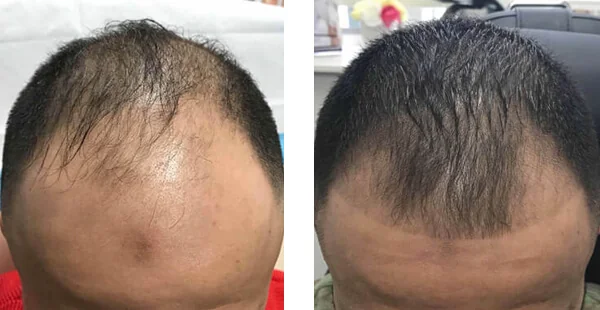 Before and After Hair Restoration