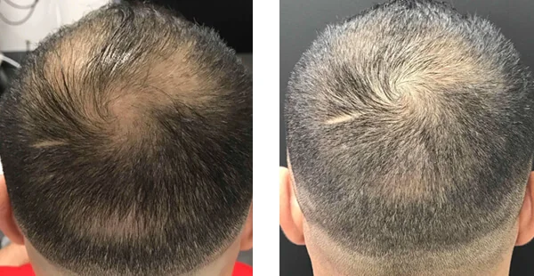 Before and After Image of Hair Restoration