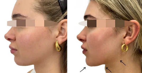 Before and After Acne Scarring Treatment