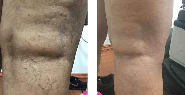 Before and After Acne Scarring Treatment