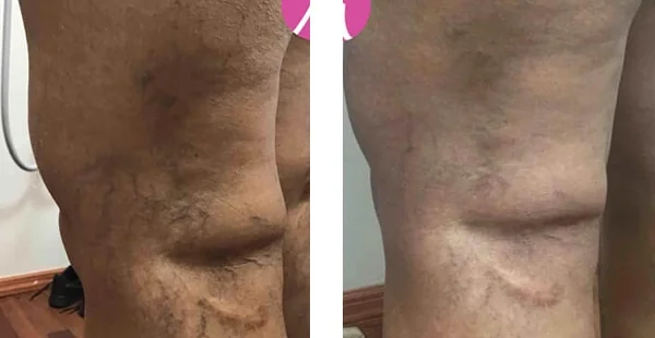 Before and After Acne Scarring Treatment