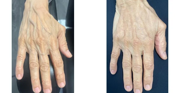 Before and After Acne Scarring Treatment