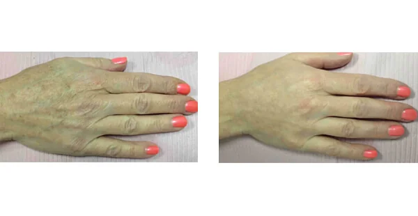 Before and After Acne Scarring Treatment