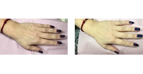 Before and After Acne Scarring Treatment