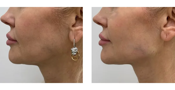Before and After Acne Scarring Treatment