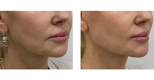 Before and After Acne Scarring Treatment