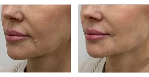 Before and After Acne Scarring Treatment