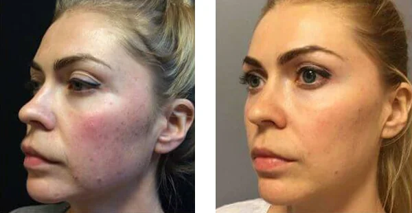 Before and After Acne Scarring Treatment