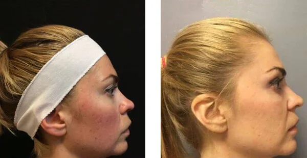 Before and After Acne Scarring Treatment