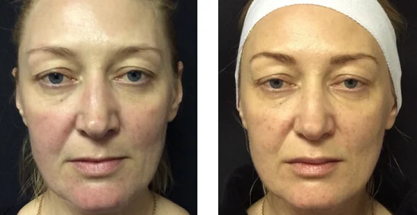 Before and After Acne Scarring Treatment