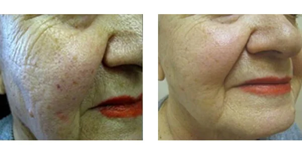 Before and After Acne Scarring Treatment