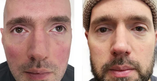 Before and After Acne Scarring Treatment