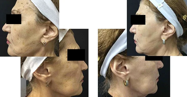 Before and After Acne Scarring Treatment