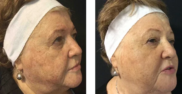 Before and After Acne Scarring Treatment