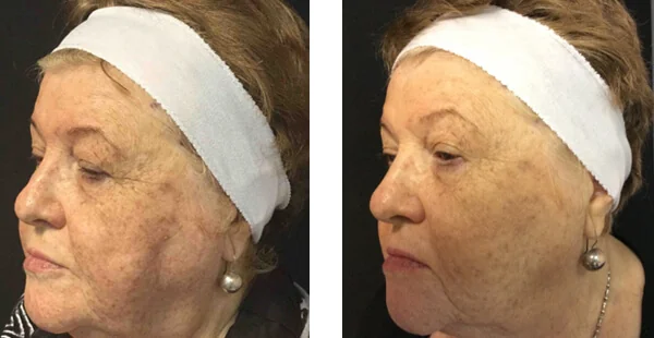 Before and After Acne Scarring Treatment