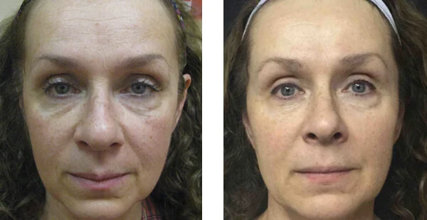 Before And After Acne Scarring Treatment