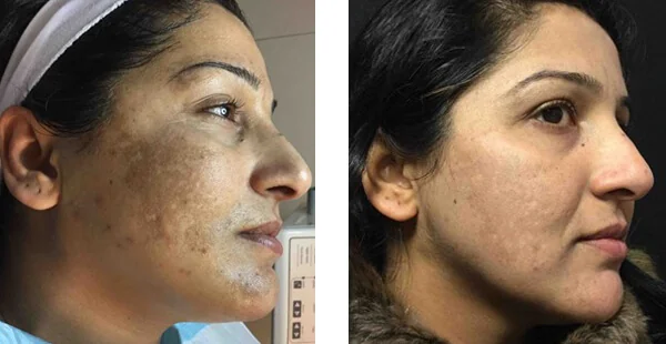 Before and After Acne Scarring Treatment