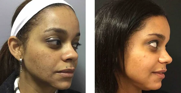 Before and After Acne Scarring Treatment