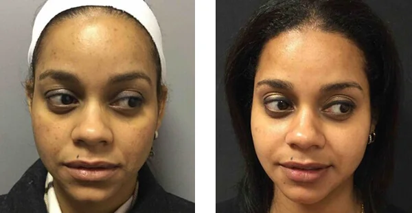 Before and After Acne Scarring Treatment
