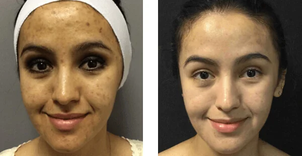 Before and After Acne Scarring Treatment