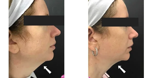 Before and After Acne Scarring Treatment