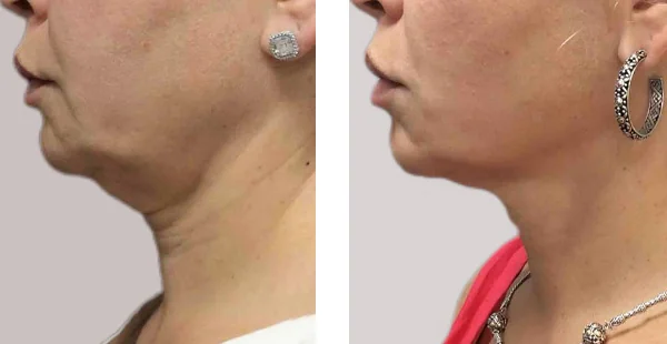 Before and After Acne Scarring Treatment