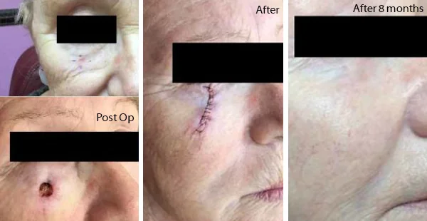 Before and After Acne Scarring Treatment