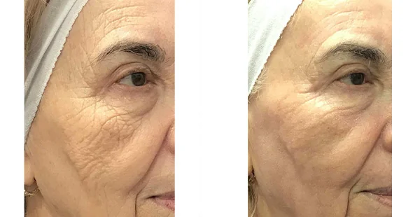 Before and After Acne Scarring Treatment