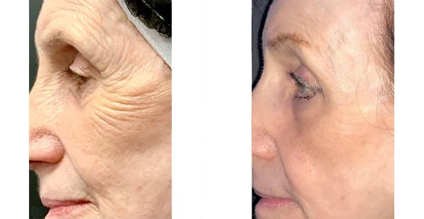 Acne Scarring Treatment