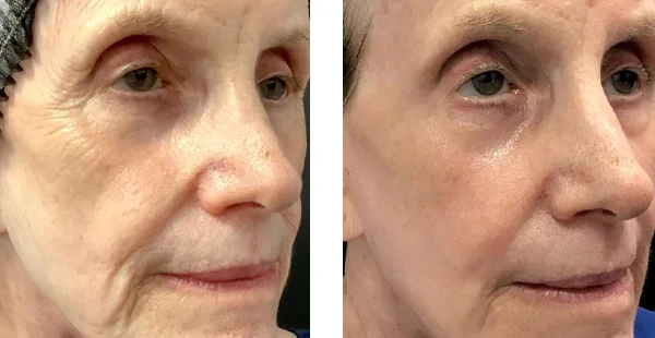 Before and After Acne Scarring Treatment