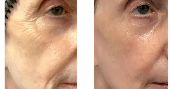 Before and After Acne Scarring Treatment