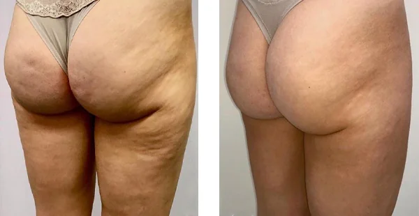 Before and After Acne Scarring Treatment