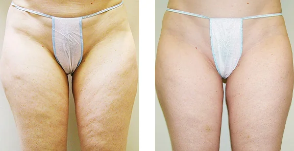 Before and After Acne Scarring Treatment